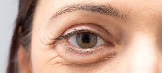 bags under eyes symptoms and how to