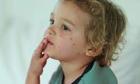 Bedbug Bites on Babies: Signs, Symptoms, & More | Pampers