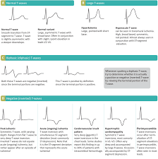 ECG interpretation: Characteristics of the normal ECG (P-wave, QRS complex,  ST segment, T-wave) – ECG & ECHO