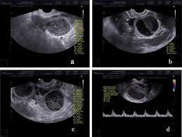 Hemorrhagic Ovarian Cysts Clinical And Sonographic