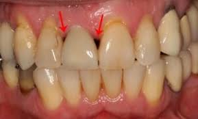 black hole disease with dental crowns