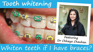 Finden sie whiten teeth auf gigagünstig, die website, um preise zu vergleichen! Can You Have Teeth Whitening With Braces On Youtube