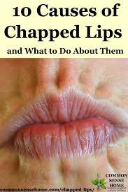 10 causes of chapped lips plus how to