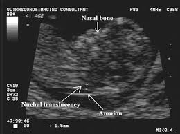 Normal Values For The Nuchal Translucency And Technique For