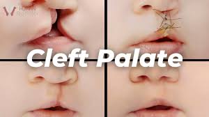 why cleft palates occur a scientific