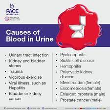 blood in urine hematuria causes