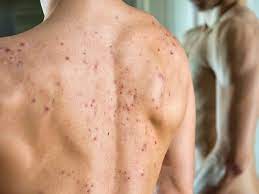 back acne how to treat it