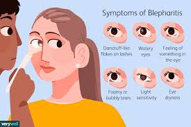 blepharitis types symptoms causes