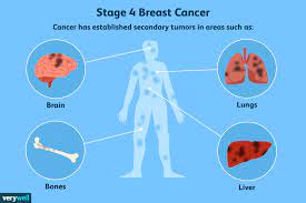 where t cancer spreads common