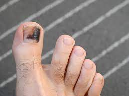 stubbed toes can result in nail bed