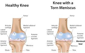 torn meniscus in knee what should you