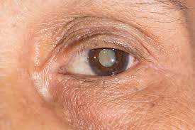 early signs of cataracts