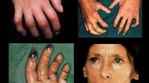 Consultorio Médico Dr. Mario A Carrillo - ESCLERODERMIA, CUANDO EL COLÁGENO  SE VUELVE ENEMIGO Esta enfermedad, también conocida como esclerosis  sistémica, se caracteriza por el endurecimiento de los tejidos de la piel,