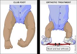 Treatment of idiopathic clubfoot has evolved over the years through different changes where surgery and conservative treatment have been competing each other. Clubfoot Treatment With A Boots And Bar Orthosis