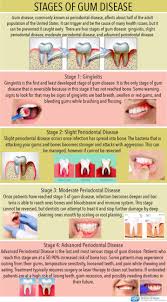 periodontal services plano tx gum