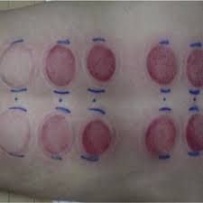 The Change In Skin Color After Cupping Participant 1