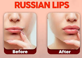 what is russian technique lip filling