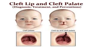 cleft lip and cleft palate diagnosis