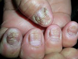 an nail dystrophy on all
