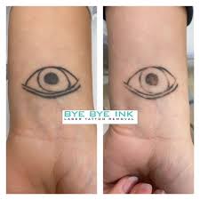 best eyebrow tattoo removal in new york