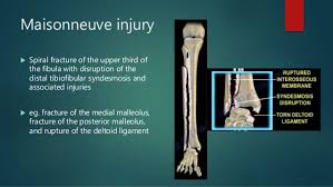 The fracture is important because treatment almost always requires surgery, and without a careful examination of the ankle (and the knee), it's possible to misdiagnose this injury. Maisonneuve Fracture