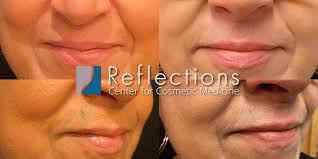 permanent makeup removal new jersey