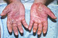 Pe can exist as a primary physiologic finding or as a secondary marker of. A Man With Erythematous And Swollen Hands Medicine Today