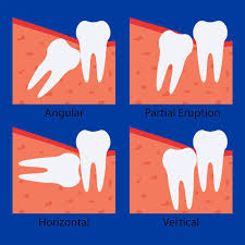 wisdom tooth extraction in singapore