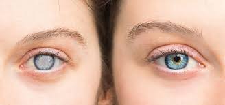 enhancing cataract surgery results 14