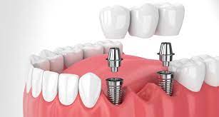 If you get dental implants, you can expect to spend $3,000 to $5,000 per tooth. Philadelphia Dental Implants Cost Faq Dr Richard Eidelson Dds