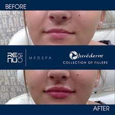 where can juvederm fillers be used on