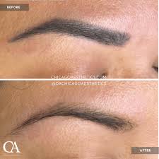 permanent makeup removal chicago