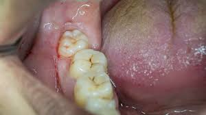 You will have a increase in swelling and muscle trismus that adds to your pain level. This Is The Most Important Thing You Can Do To Relieve Wisdom Tooth Pain