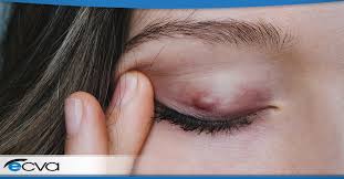 what is a stye eye care vision