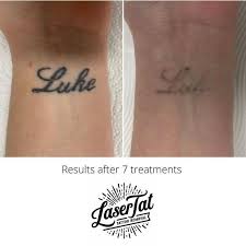 laser tattoo removal how long until