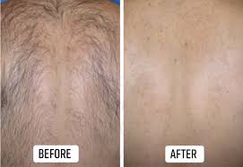 Acadia cosmetic & laser centre acadia cosmetic & laser centre offers laser hair removal, botox cosmetic, stretch marks and scar reduction, skin location : Gallery Saskastchewan