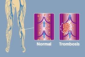 Thrombosis is the formation of a blood clot inside a blood vessel, obstructing the flow of blood through the circulatory system. Trombosis Que Es Sintomas Y Como Se Realiza El Tratamiento Tua Saude