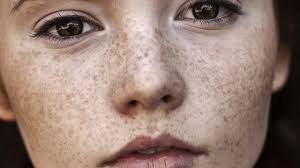 home remes to help get rid of dark spots