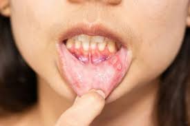 mouth ulcers tips 5 home remes to