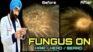 cure fungal infection on scalp head