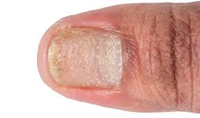 nail disease mohave skin and cancer
