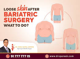 loose skin after bariatric surgery