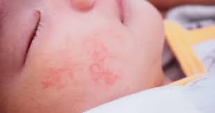 prevent heat rash in children