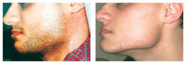 laser hair removal for men houston