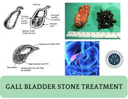 Homeopathic Treatment Of Gallbladder Stones Case Study