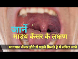 A canker sore looks like an ulcer, usually. à¤œ à¤¨ à¤® à¤‰à¤¥ à¤• à¤¸à¤° à¤• à¤²à¤• à¤·à¤£ à¤• à¤¬ à¤° à¤® Symptoms Of Mouth Cancer Mouth Cancer Oral Cancer Youtube