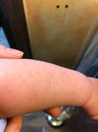 rash allergic reaction dry skin