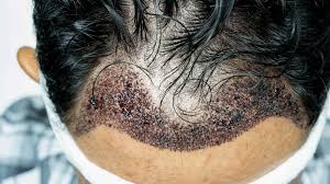 hair transplant infection everything