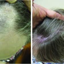 a patch of frontal fibrosing alopecia