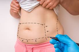 weight can you lose with a tummy tuck